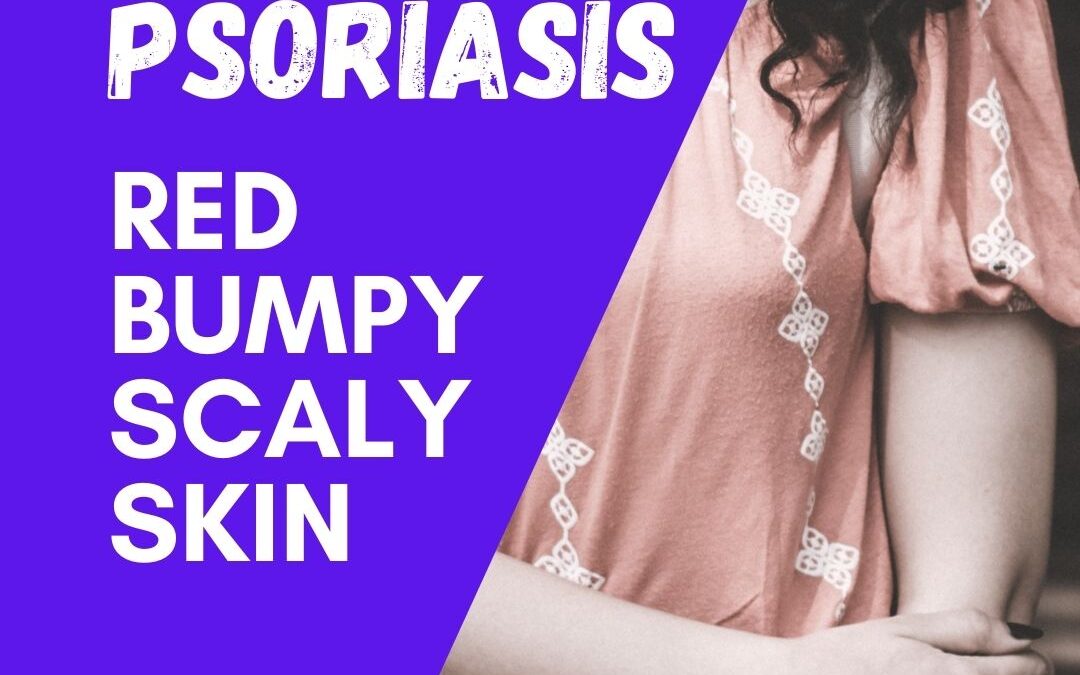 Psoriasis & Natural Skincare 76