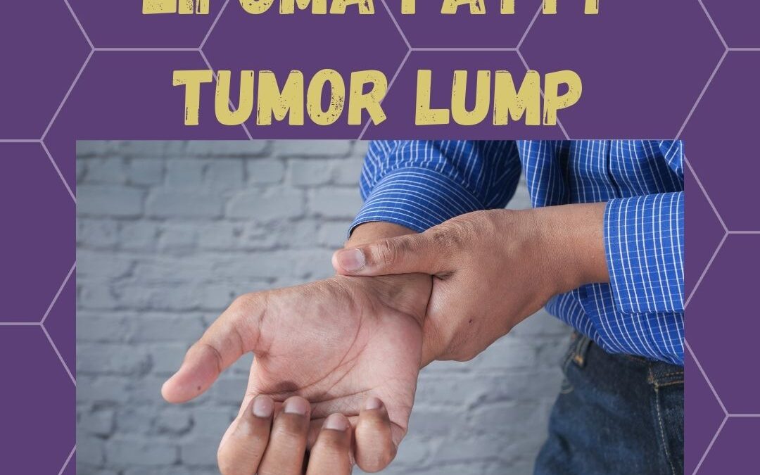 Lipoma: Fatty Tumor Lump: HealingMatters 96